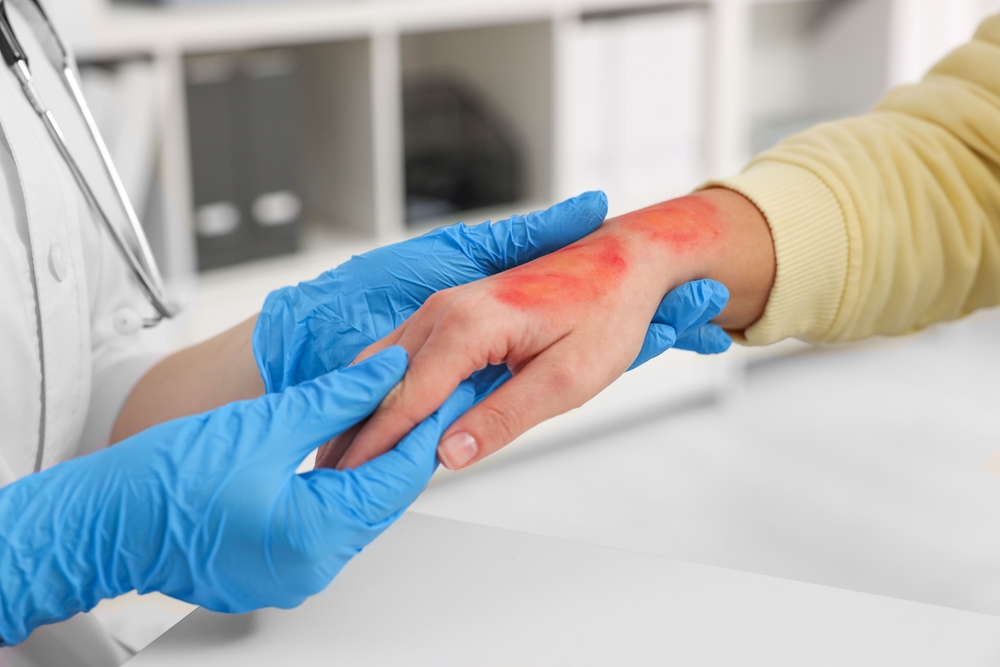 Doctor examining a patient's burned hand