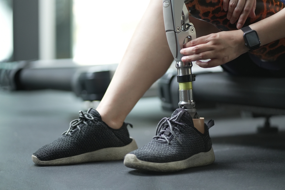Woman with a prosthetic leg exercising on a treadmill in a gym